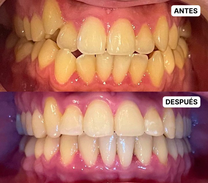 CERO CARIES - CASO1-ok