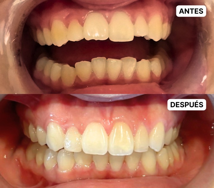 CERO CARIES - CASO3