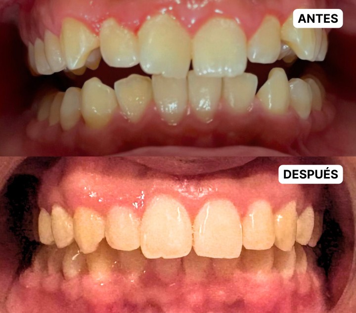 CERO CARIES - CASO4